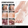 toenail fungus treatment